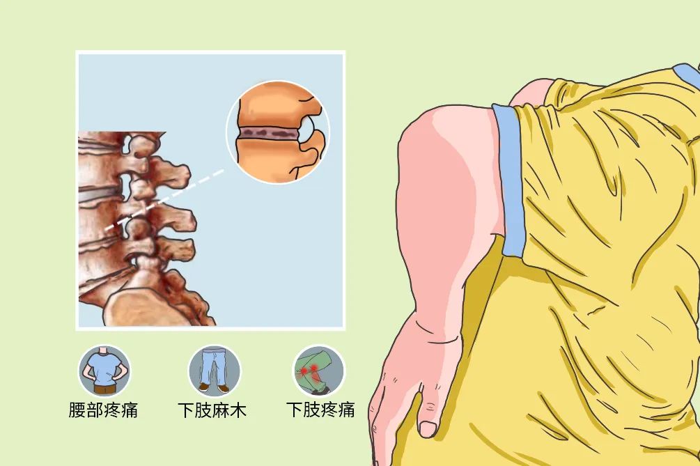 有氧运动腰椎疼吗_有氧运动对腰椎有好处吗_腰椎痛运动缓解了什么原因